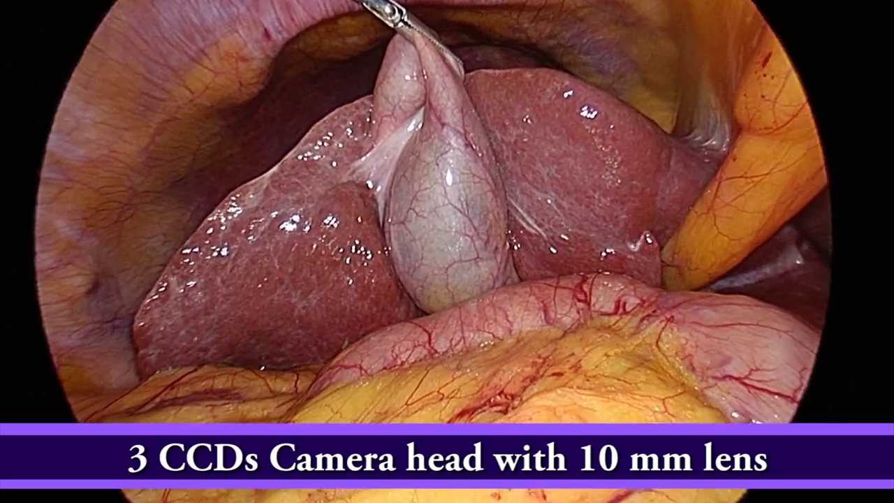 [HD 1080p] – Comparison of Videos from 7 Laparoscopic Cameras ( Olympus ) In the Same Patient
